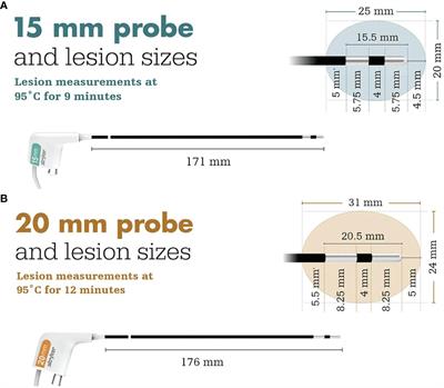 The safety and efficacy of the Stryker OptaBlate™ Bone Tumor Ablation system for vertebral body metastases